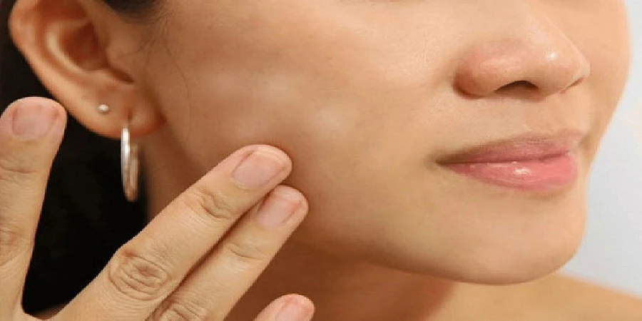 কদমা বা ছুলি প্রাকৃতিক উপায়ে নিরাময়